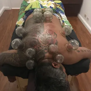 Chinese Fire cupping