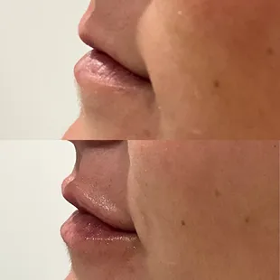 Lips Before &amp; After