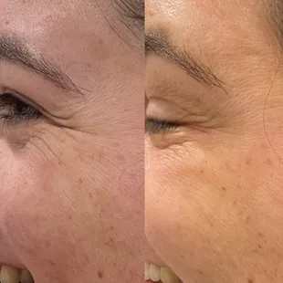 Tox Before &amp; After