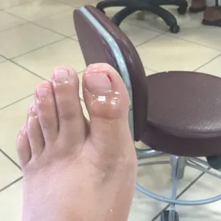 You can see the blood starting to come out from the technician cutting into my nail bed.