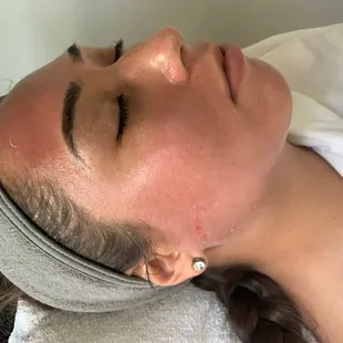 Micro needling and healed combo brows