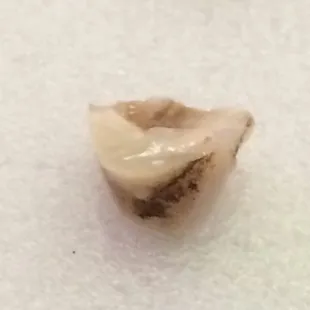 I still can&apos;t believe this horrible piece of tooth was in my mouth and came in my taco