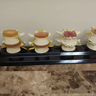 Different views of vertebra and disc to use as an aid in advising patient of the condition of their back.