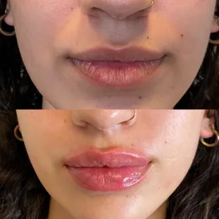 Gorgeous &amp; natural Lip Filler