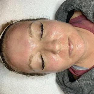 Post microneedling glow, this patients collagen will be working overtime to heal the micro punctures and fill in those fine lines