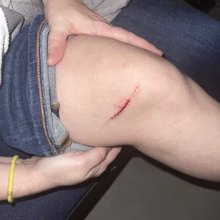 Sharp bar caused this, while it was dark in the theater it is hard to see. The exposed bar was rusty