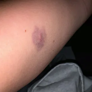 Bruise 1 of many