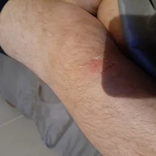 Bruised