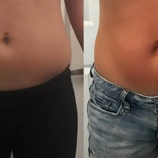 Cryo Body Sculpting Before and After
