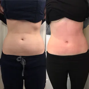 Before and After of Cryo Body Sculpting