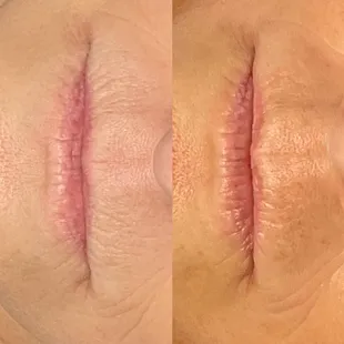 Microchanneling after 3 treatments