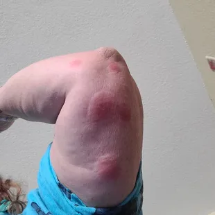 BED BUG BITES