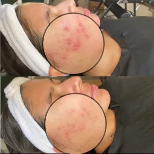 We are here to help you clear up acne and feel happy in your skin.  Let's get started today!