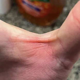 Skin Burn in Better Lighting