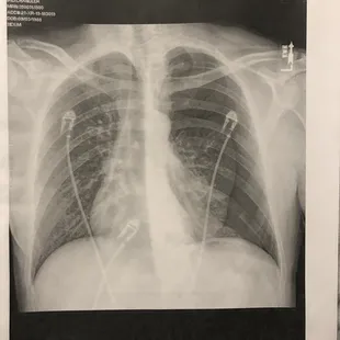 X-ray done in Phoenix showing a left side Pneumothorax