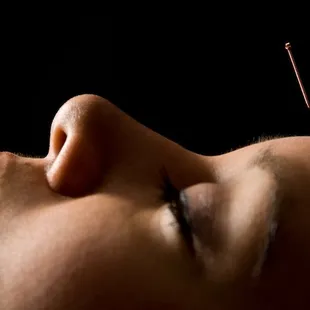 Acupuncture can help manage pain and resolve illnesses