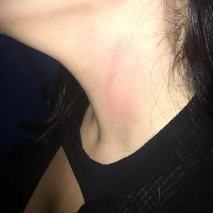 The mark on her neck from being hit by a ball that their bouncer hit with a bat.