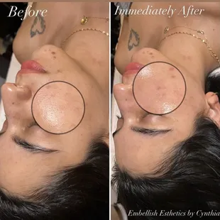 Dermalplaning Facial by Cynthia S.