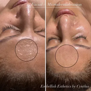 Micro dermabrasion facial by Cynthia S