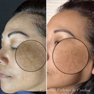 Hyper pigmentation, chemical peel by Cynthia S.