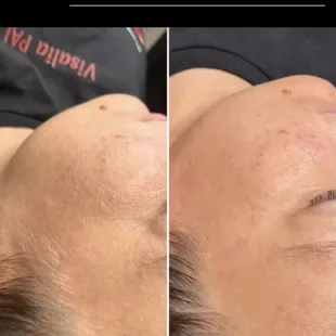 Dermalplaning + peel treatment by Cynthia S