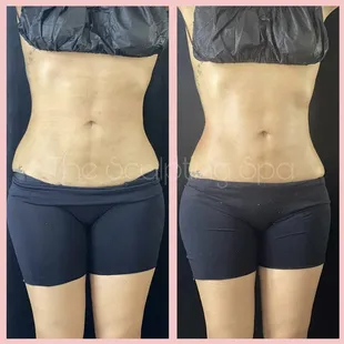 Lymphatic massages &amp; wood therapy