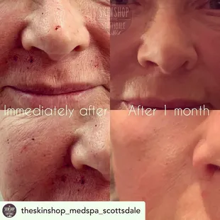 Vivace RF Microneedling gives you results with as little as one treatment.  Immediate results and no down time!! Virtually pain free.