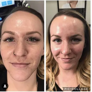 Our skin is the largest organ in our body.  Nurture it with a HydraFacial. 3 steps, 30 minutes for the best skin of your life!