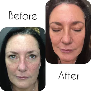 After years of sun damage this guest developed dark pigment and fine lines and wrinkles.  One VI Peel gave her amazing results!!