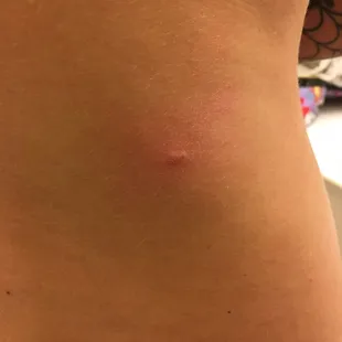One of my lovely bedbug bites.