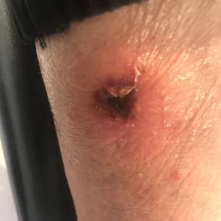 Sores on my mom- even bed sores