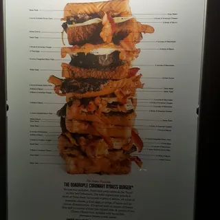 Quadruple Coronary Bypass (the Super-Stack)