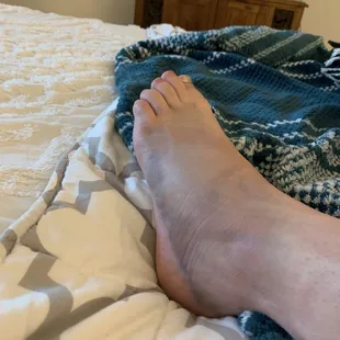 The injury - I landed to the side of my foot with all my body weight