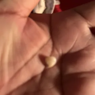 This is my cracked tooth