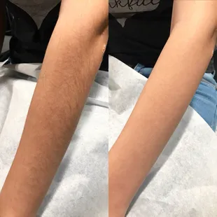 Before &amp; After full arm wax