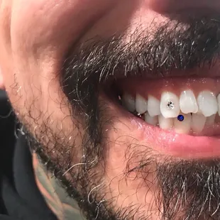 Tooth gems