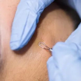 Deep pore cleansing extractions.