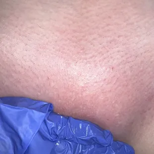 After Brazilian waxing
