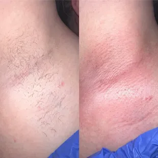 Before and after armpit waxing