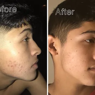 Acne treatment post 4 weeks. One professional treatment with home care.