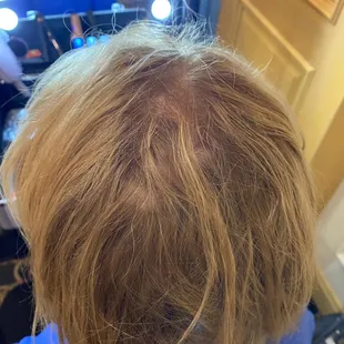 Before hair topper, noticeable hair loss.