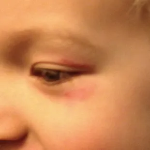 My child's bruises after an assault by another student at this Tutor Time location