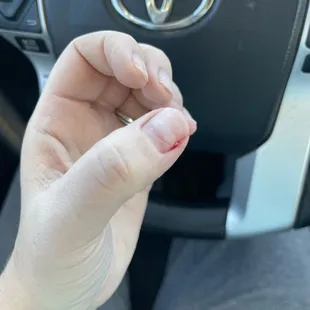 Example of one nail bleeding