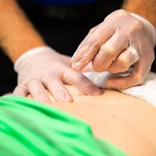 Trigger Point Dry Needling