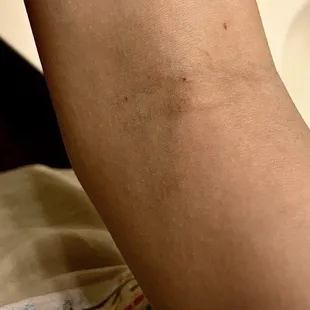 Bruise from botched blood draw on my teen daughter.