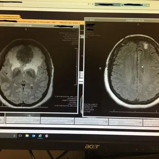 MRIs taken at UNMH, about three months apart.