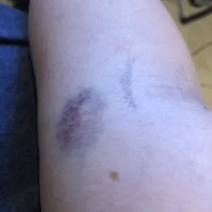 Two days later. Triage nurse arm. But the bruising and broken vessels were immediate because of the wiggling