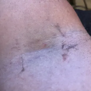 1st attempt from triage nurse, bad light.