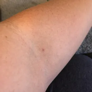 Proper IV administration from the one good nurse.