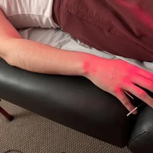 Relaxing during acupuncture session